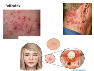 Folliculitis
 