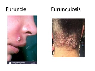 Furuncle Furunculosis
 