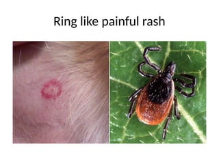 Ring like painful rash
 
