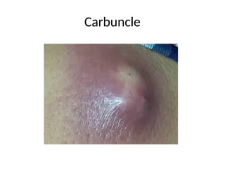 Carbuncle
 