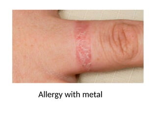 Allergy with metal
 
