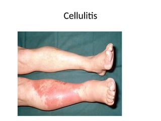 Cellulitis
 