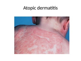Atopic dermatitis
 