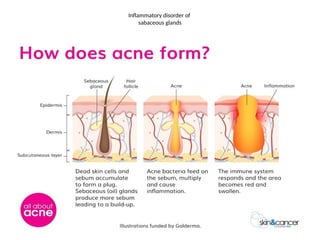 Inflammatory disorder of
sabaceous glands
 