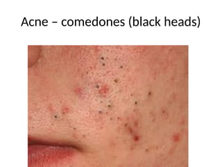 Acne – comedones (black heads)
 