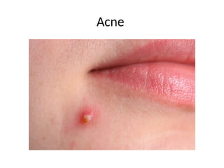 Acne
 