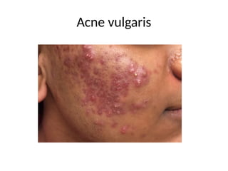 Acne vulgaris
 
