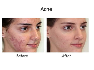 Acne
 