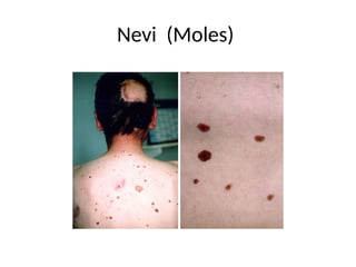 Nevi (Moles)
 