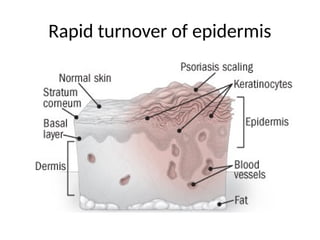 Rapid turnover of epidermis
 
