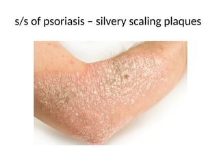 s/s of psoriasis – silvery scaling plaques
 