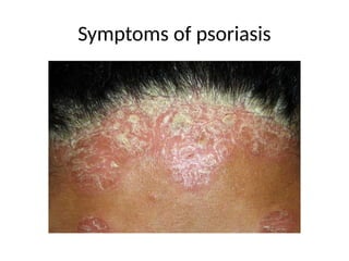 Symptoms of psoriasis
 
