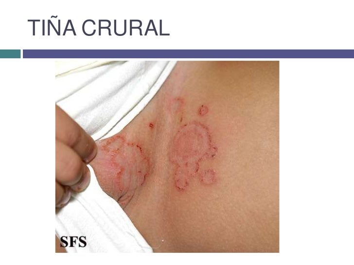 La psoriasis la forma de la piel con la hemorragia