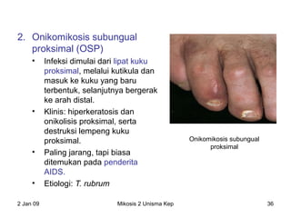 2. Onikomikosis subungual
proksimal (OSP)
• Infeksi dimulai dari lipat kuku
proksimal, melalui kutikula dan
masuk ke kuku yang baru
terbentuk, selanjutnya bergerak
ke arah distal.
• Klinis: hiperkeratosis dan
onikolisis proksimal, serta
destruksi lempeng kuku
proksimal.
• Paling jarang, tapi biasa
ditemukan pada penderita
AIDS.
• Etiologi: T. rubrum
2 Jan 09 Mikosis 2 Unisma Kep 36
Onikomikosis subungual
proksimal
 