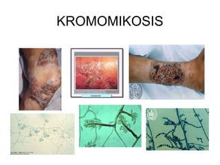 KROMOMIKOSIS
 
