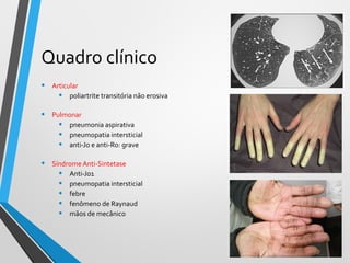 Quadro clínico
• Articular
• poliartrite transitória não erosiva
• Pulmonar
• pneumonia aspirativa
• pneumopatia intersticial
• anti-Jo e anti-Ro: grave
• Síndrome Anti-Sintetase
• Anti-Jo1
• pneumopatia intersticial
• febre
• fenômeno de Raynaud
• mãos de mecânico
 