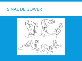 SINAL DE GOWER
 