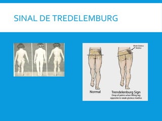 SINAL DE TREDELEMBURG
 