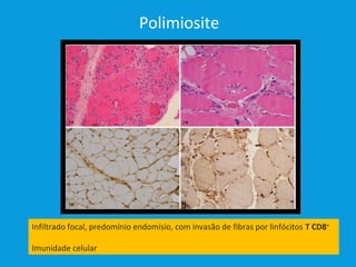Polimiosite
Infiltrado focal, predomínio endomísio, com invasão de fibras por linfócitos T CD8+
Imunidade celular
 