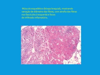 Músculo esquelético (bíceps braquial), mostrando
variação de diâmetro das fibras, com atrofia das fibras
nos fascículos à esquerda e focos
de infiltrado inflamatório.
 