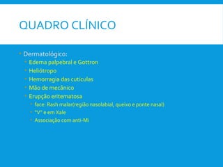 QUADRO CLÍNICO
• Dermatológico:
• Edema palpebral e Gottron
• Heliótropo
• Hemorragia das cuticulas
• Mão de mecânico
• Erupção eritematosa
• face: Rash malar(região nasolabial, queixo e ponte nasal)
• “V” e em Xale
• Associação com anti-Mi
 