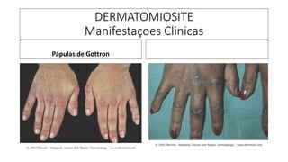 DERMATOMIOSITE
Manifestaçoes Clinicas
Pápulas de Gottron
 