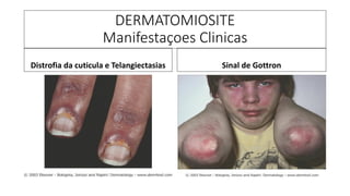 DERMATOMIOSITE
Manifestaçoes Clinicas
Distrofia da cuticula e Telangiectasias Sinal de Gottron
 