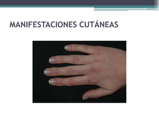 MANIFESTACIONES CUTÁNEAS
 