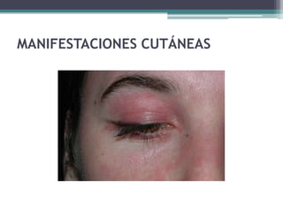 MANIFESTACIONES CUTÁNEAS
 