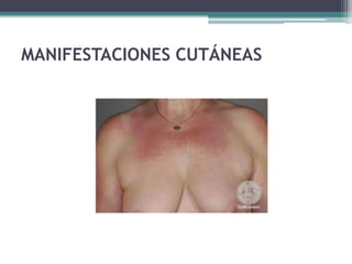 MANIFESTACIONES CUTÁNEAS
 