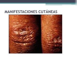 MANIFESTACIONES CUTÁNEAS
 