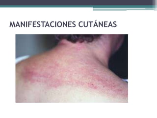 MANIFESTACIONES CUTÁNEAS
 