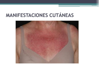 MANIFESTACIONES CUTÁNEAS
 