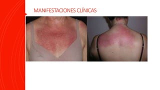 MANIFESTACIONES CLÍNICAS
 