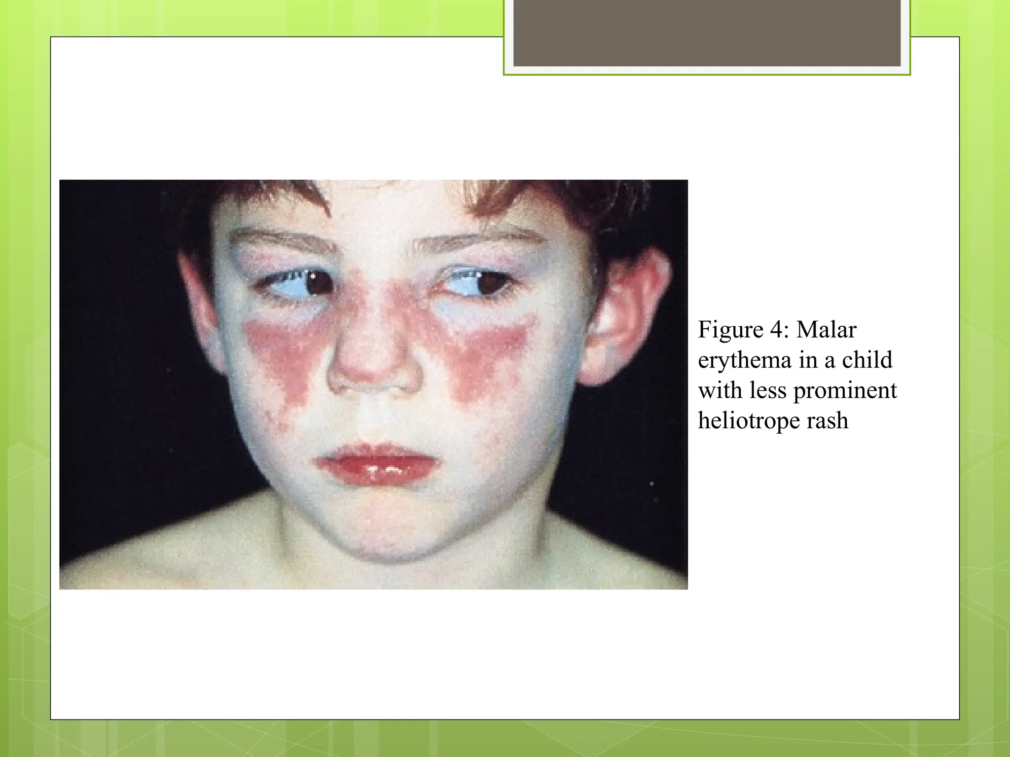 Haliotrop Rash DERMATOMIOSITIS. MARIUXI.ppt diagnóstico | PPT