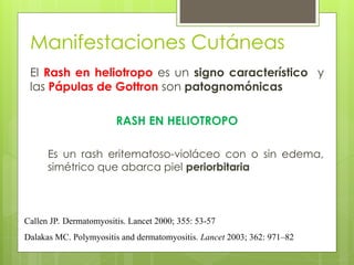 Manifestaciones Cutáneas
El Rash en heliotropo es un signo característico y
las Pápulas de Gottron son patognomónicas
RASH EN HELIOTROPO
Es un rash eritematoso-violáceo con o sin edema,
simétrico que abarca piel periorbitaria
Callen JP. Dermatomyositis. Lancet 2000; 355: 53-57
Dalakas MC. Polymyositis and dermatomyositis. Lancet 2003; 362: 971–82
 