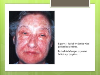 Figure 1: Facial erythema with
periorbital oedema.
Periorbital changes represent
heliotrope eruption.
 