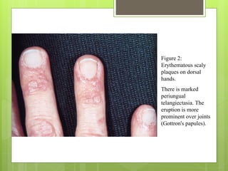Figure 2:
Erythematous scaly
plaques on dorsal
hands.
There is marked
periungual
telangiectasia. The
eruption is more
prominent over joints
(Gottron's papules).
 