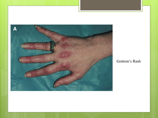 Gottron’s Rash
 