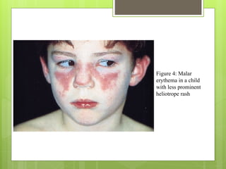 Figure 4: Malar
erythema in a child
with less prominent
heliotrope rash
 