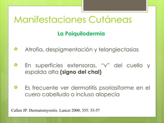 Manifestaciones Cutáneas
La Poiquilodermia
 Atrofia, despigmentación y telangiectasias
 En superficies extensoras, “v” del cuello y
espalda alta (signo del chal)
 Es frecuente ver dermatitis psoriasiforme en el
cuero cabelludo o incluso alopecia
Callen JP. Dermatomyositis. Lancet 2000; 355: 53-57
 