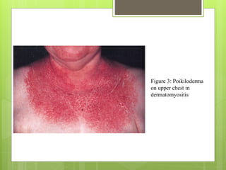 Figure 3: Poikiloderma
on upper chest in
dermatomyositis
 