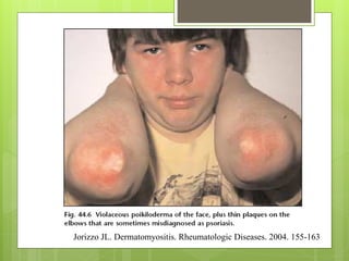 Jorizzo JL. Dermatomyositis. Rheumatologic Diseases. 2004. 155-163
 