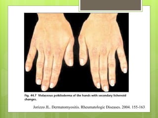 Jorizzo JL. Dermatomyositis. Rheumatologic Diseases. 2004. 155-163
 