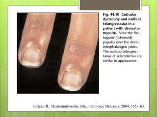 Jorizzo JL. Dermatomyositis. Rheumatologic Diseases. 2004. 155-163
 