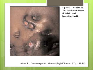 Jorizzo JL. Dermatomyositis. Rheumatologic Diseases. 2004. 155-163
 