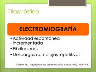 Diagnóstico
Dalakas MC. Polymyositis and dermatomyositis. Lancet 2003; 362: 971–82
 