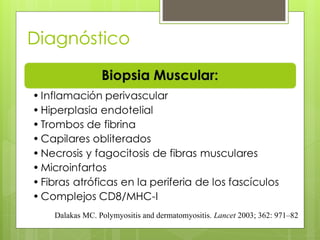 Diagnóstico
Dalakas MC. Polymyositis and dermatomyositis. Lancet 2003; 362: 971–82
 