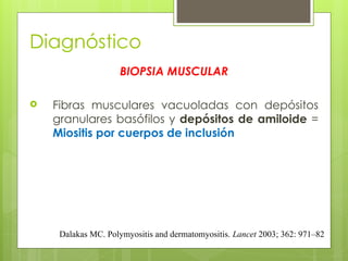 Diagnóstico
BIOPSIA MUSCULAR
 Fibras musculares vacuoladas con depósitos
granulares basófilos y depósitos de amiloide =
Miositis por cuerpos de inclusión
Dalakas MC. Polymyositis and dermatomyositis. Lancet 2003; 362: 971–82
 