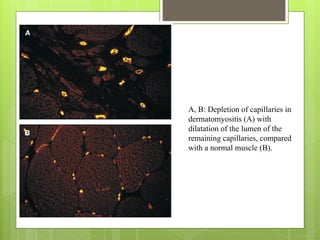 A, B: Depletion of capillaries in
dermatomyositis (A) with
dilatation of the lumen of the
remaining capillaries, compared
with a normal muscle (B).
 